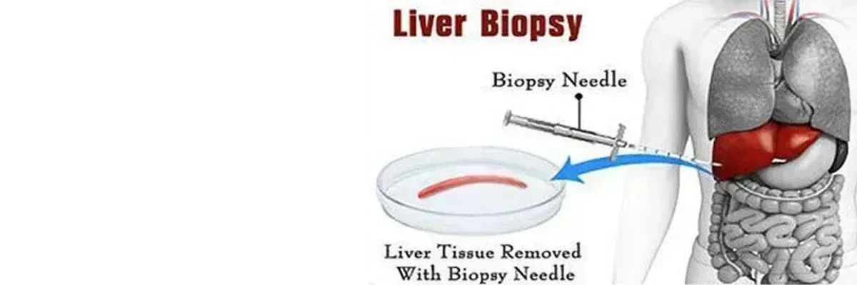 LIVER BIOPSY